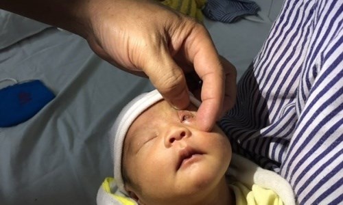Canh bao nguy co mu mat khi tu y nho nuoc chanh hinh anh