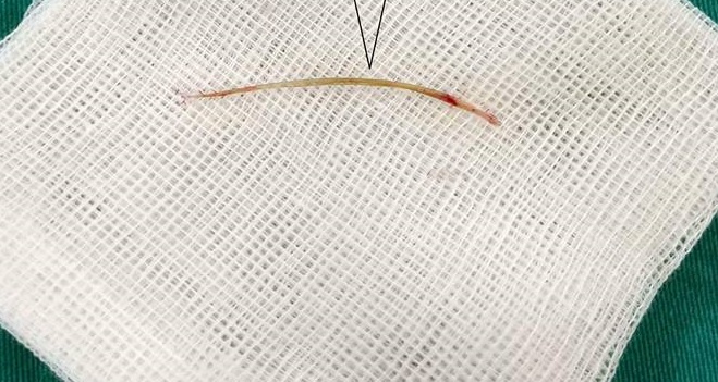 xương cá đâm thủng ruột ảnh 1 xuong ca dam thung ruot anh 1