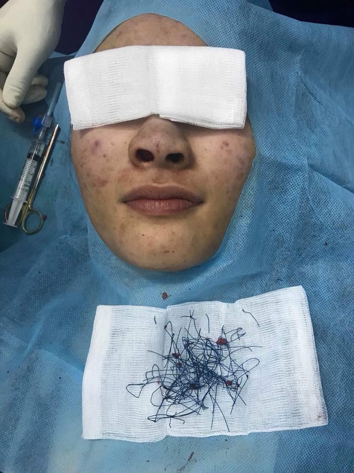 nâng mũi bằng chỉ xanh ảnh 1 nang mui bang chi xanh anh 1