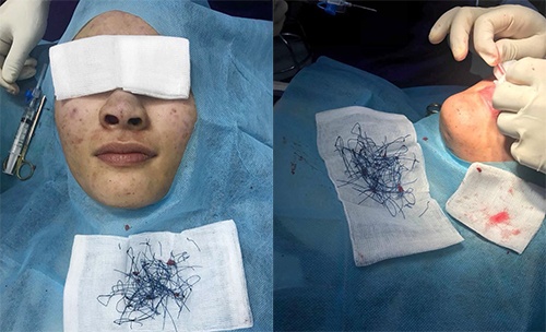 Bui chi xanh trong mui cua co gai sau khi 'dao keo' hinh anh