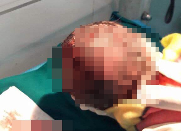 Thai nhi bi rach dau vi me chong dung dao giup con dau tu de tai nha hinh anh