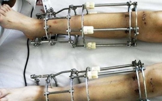 Bac si noi ve viec chan dai ra khi duoc keo hinh anh