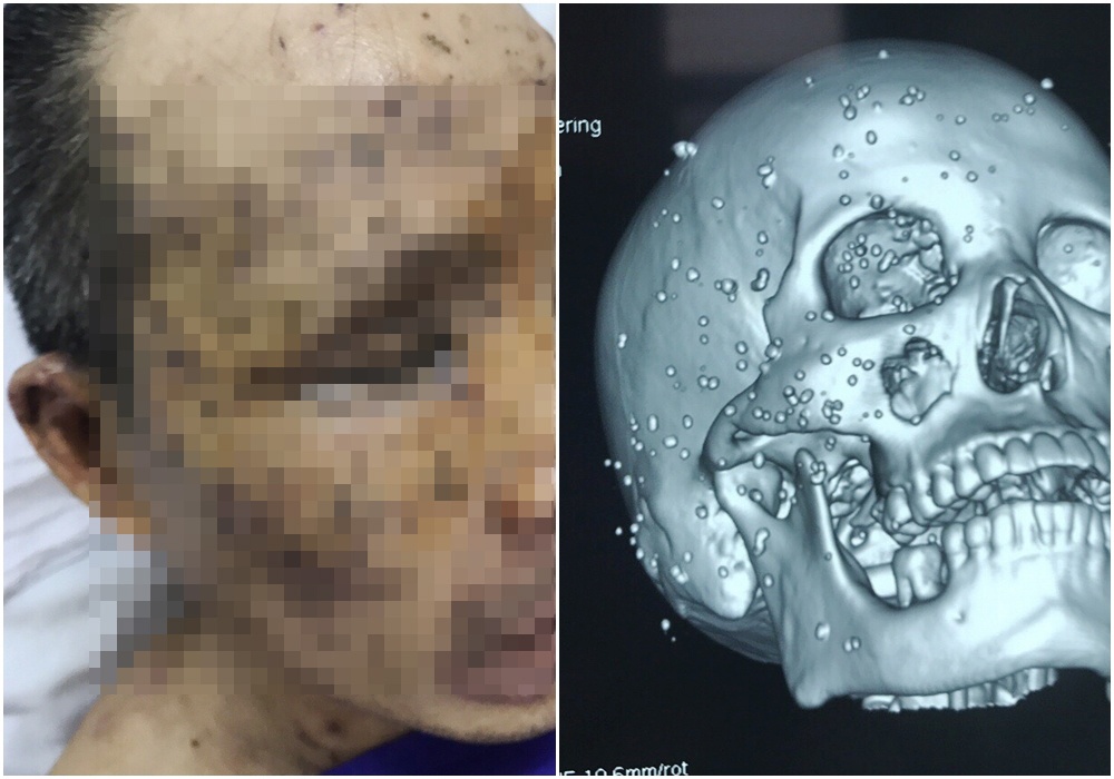 Hon 100 di vat gam khap mat nguoi dan ong sau tai nan hinh anh