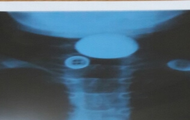 bé trai nuốt đồng xu ảnh 1 be trai nuot dong xu anh 1