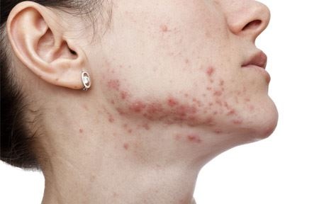 Sai lam khien da bi hong sau khi dieu tri bang laser hinh anh