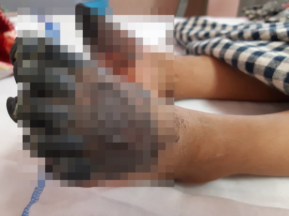 Sau vet phong o tay chan, be gai 3 tuoi phai cat bo tu chi hinh anh