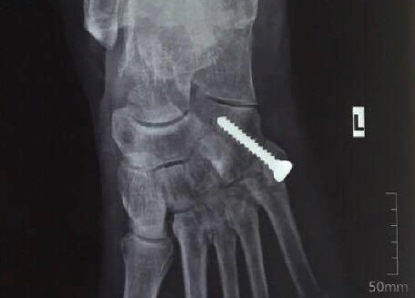 Phat hien chan thuong bi mat sau cu nga cach day 20 nam hinh anh