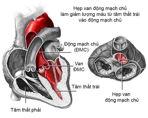 8X mắc bệnh tim mang bầu ảnh 1 8X mac benh tim mang bau anh 1