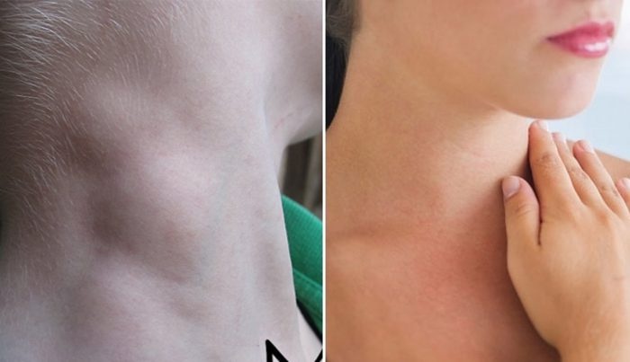 Nguoi phu nu phat hien ung thu di can sau khi thay tuc nang vung co hinh anh