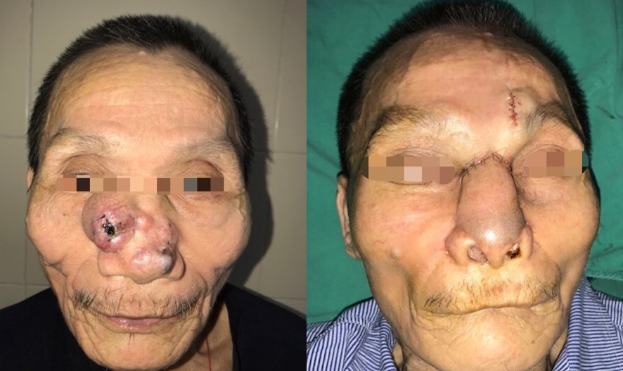 Phat hien ung thu da tu not la ben vung mui hinh anh