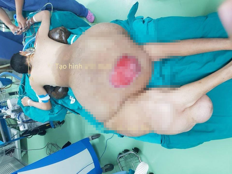 Khối u khổng lồ đè toàn bộ phần lưng ảnh 1 Khoi u khong lo de toan bo phan lung anh 1