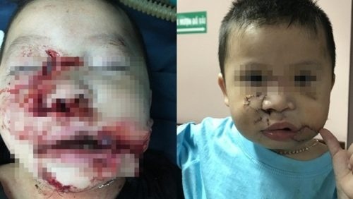 chó cắn nát mặt ảnh 1 cho can nat mat anh 1