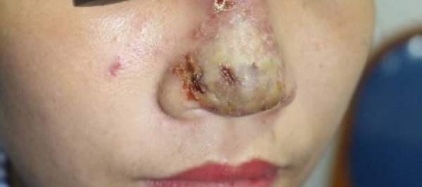 Mui xuat hien o mu sau khi tiem filler hinh anh