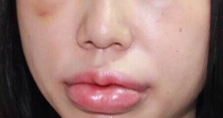 Mat bien dang sau khi tiem filler hinh anh