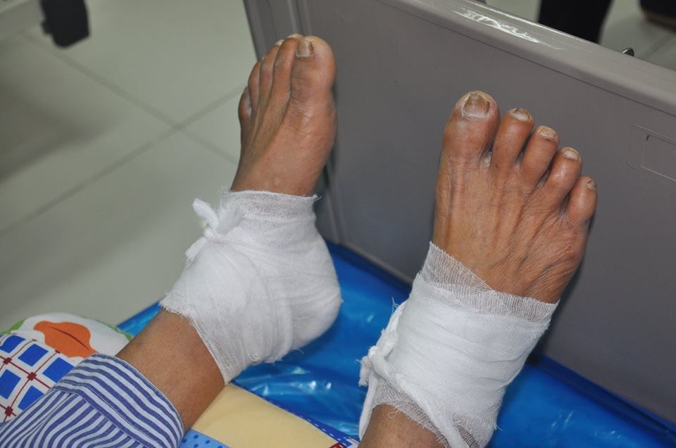 chườm nóng bằng lá ảnh 2 chuom nong bang la anh 2