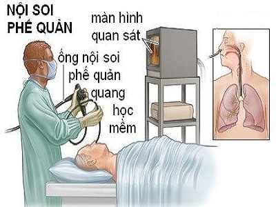 Nguyen nhan khien nu benh nhan tu vong khi noi soi anh 1