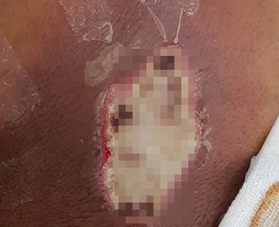 Vung vai hoai tu nang sau khi nan nhot hinh anh