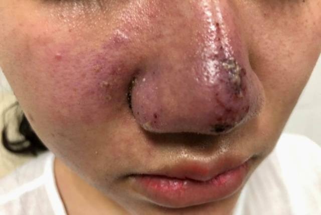 Nhieu benh nhan vao vien cau cuu bac si sau khi tiem filler hinh anh