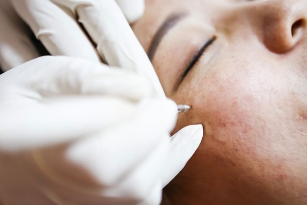 Phat hien mac ung thu sau khi di tay not ruoi hinh anh