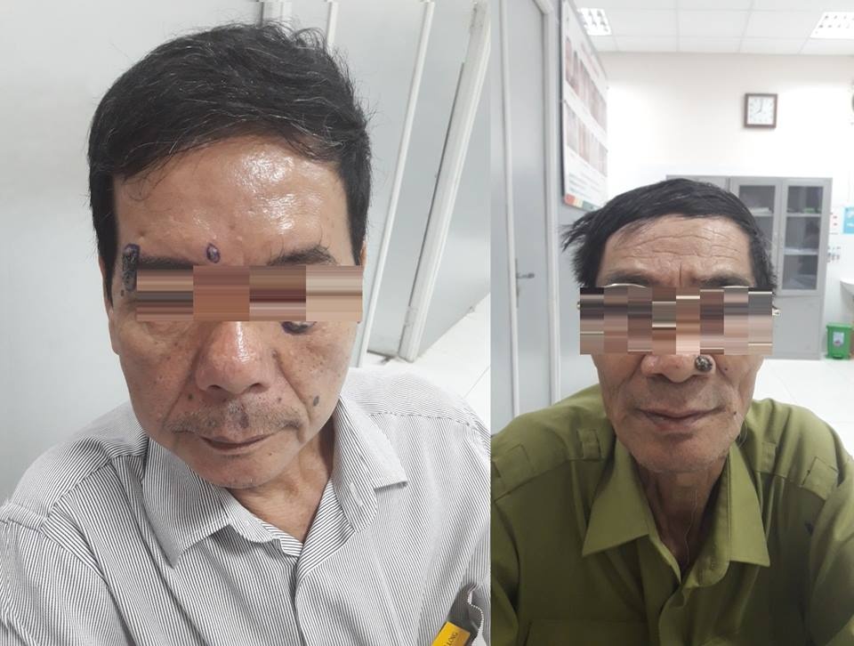 Phat hien mac ung thu sau khi di tay not ruoi anh 1