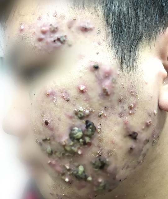 kem trị trứng cá mua qua mạng ảnh 1 kem tri trung ca mua qua mang anh 1