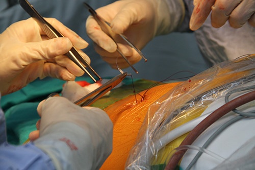 Viem tuy cap nguy hiem the nao? hinh anh