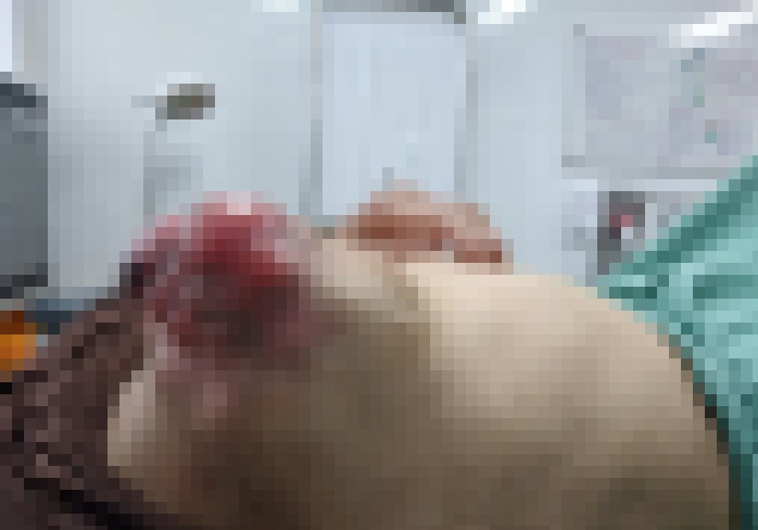 Nguc sung phong, chay mu lo loet vi dap la chua ung thu hinh anh