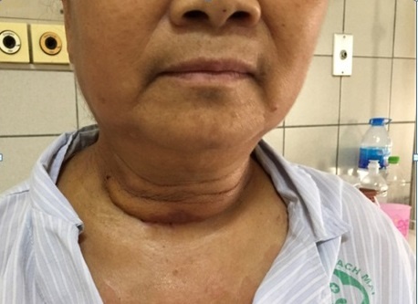 Khoi u khong lo nam trong long nguc suot 10 nam hinh anh