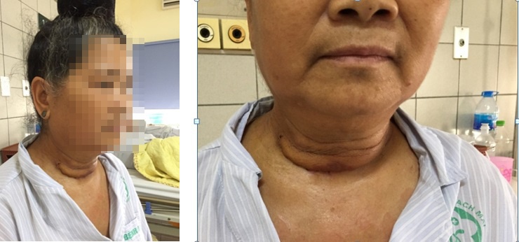Khối u khổng lồ trong lồng ngực ảnh 1 Khoi u khong lo trong long nguc anh 1