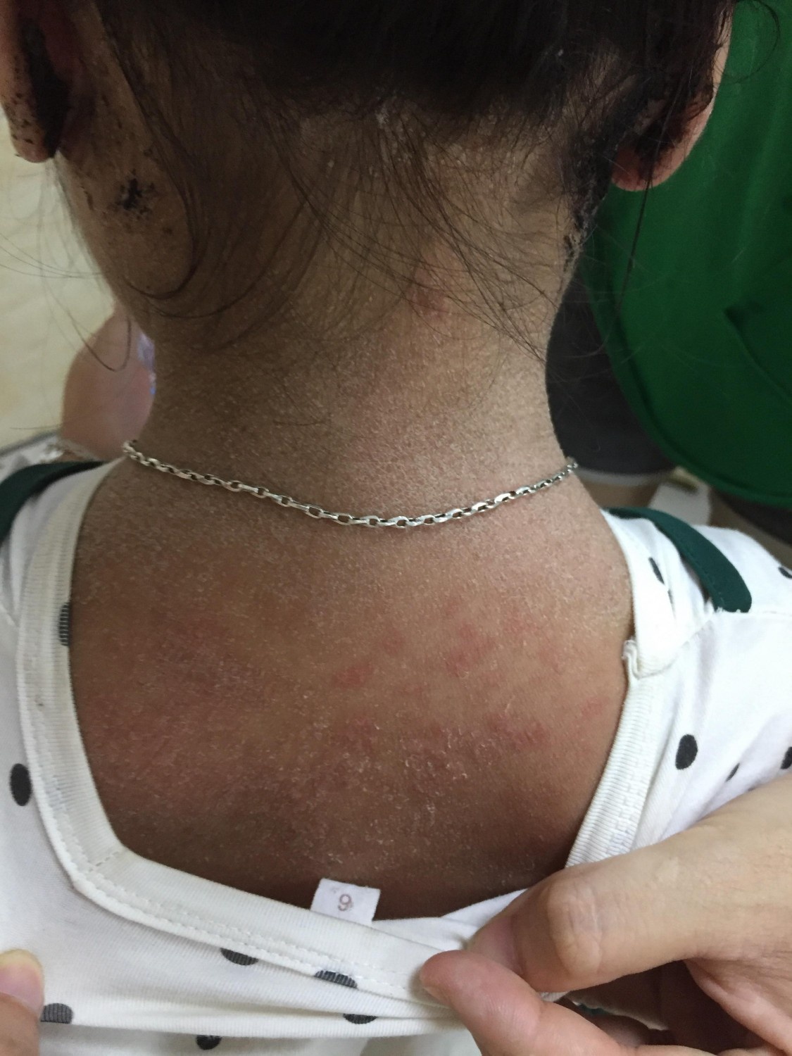 hội chứng bong vảy da do tụ cầu ảnh 1 hoi chung bong vay da do tu cau anh 1