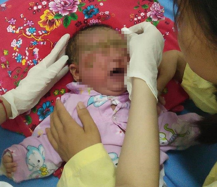 Bé trai một tháng tuổi chảy mủ toàn thân ảnh 1 Be trai mot thang tuoi chay mu toan than anh 1