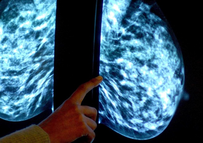 Thieu nu mac ung thu vu giai doan cuoi anh 1