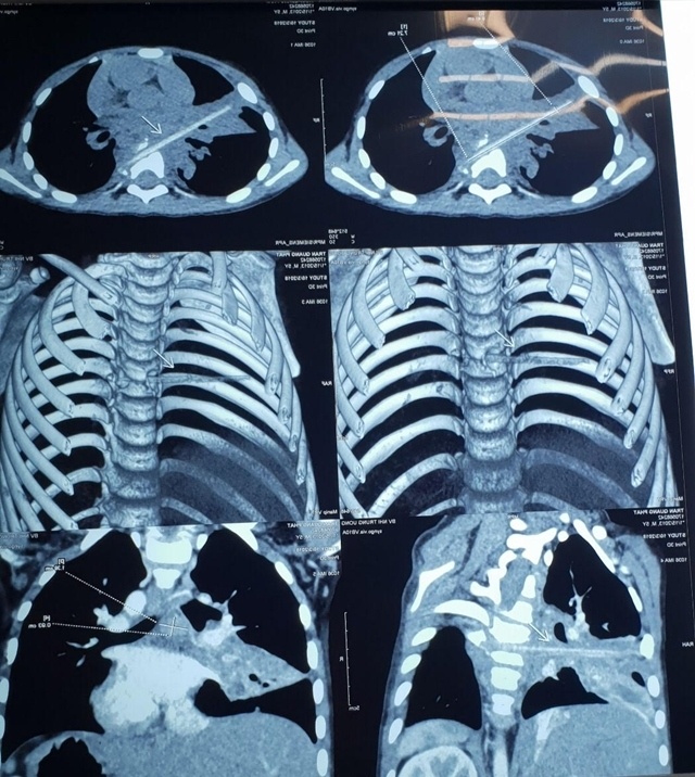 Que xiên thịt nướng khiến bé 5 tuổi vỡ đốt sống ảnh 1 Que xien thit nuong khien be 5 tuoi vo dot song anh 1