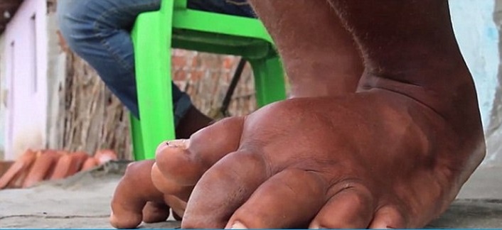 Viet Nam chinh thuc xoa so benh chan voi hinh anh