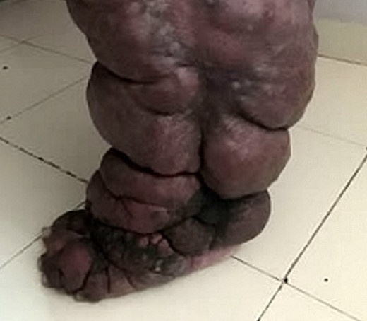 xoa so benh chan voi anh 1