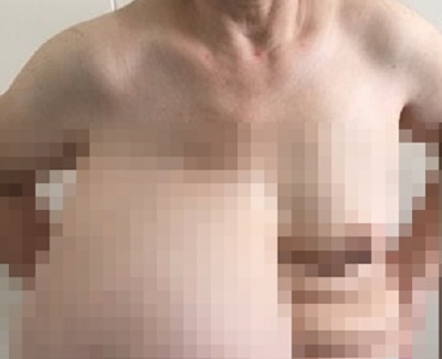 Nguoi phu nu lech cot song vi nguc nang 9 kg hinh anh