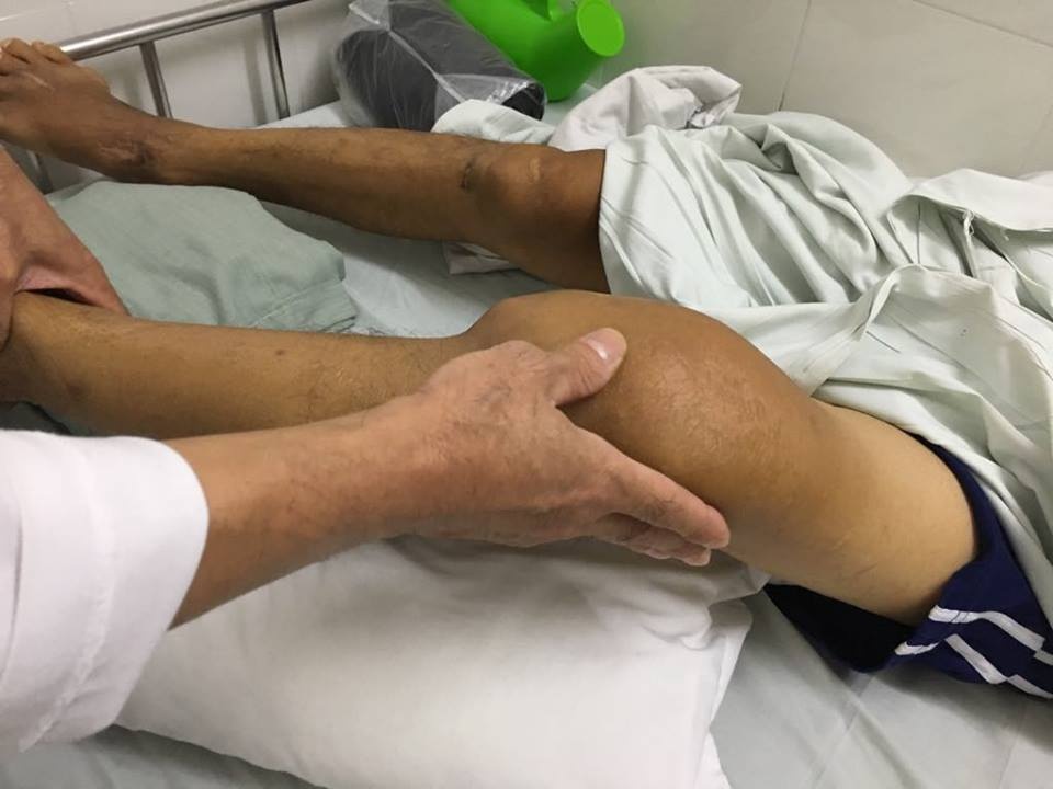 Tai sao nguoi benh gout so bia hon ruou? hinh anh