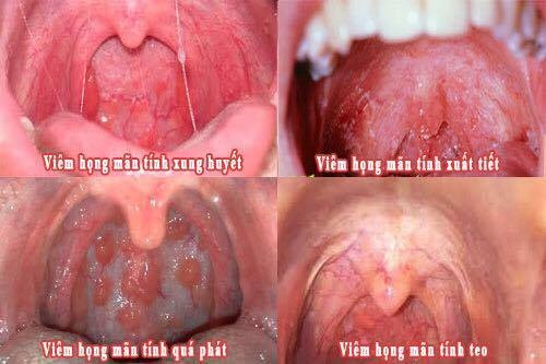 Viêm họng mãn tính  ảnh 1 Viem hong man tinh anh 1