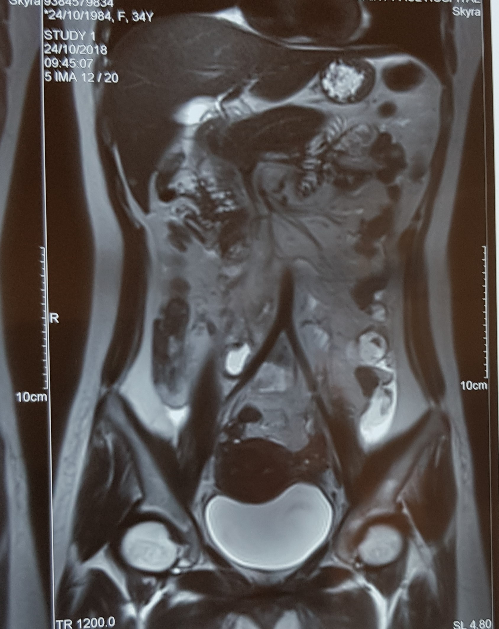 Nguoi phu nu mang thai trong o bung anh 1