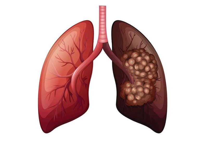Hon 20.000 nguoi Viet chet vi ung thu phoi moi nam hinh anh