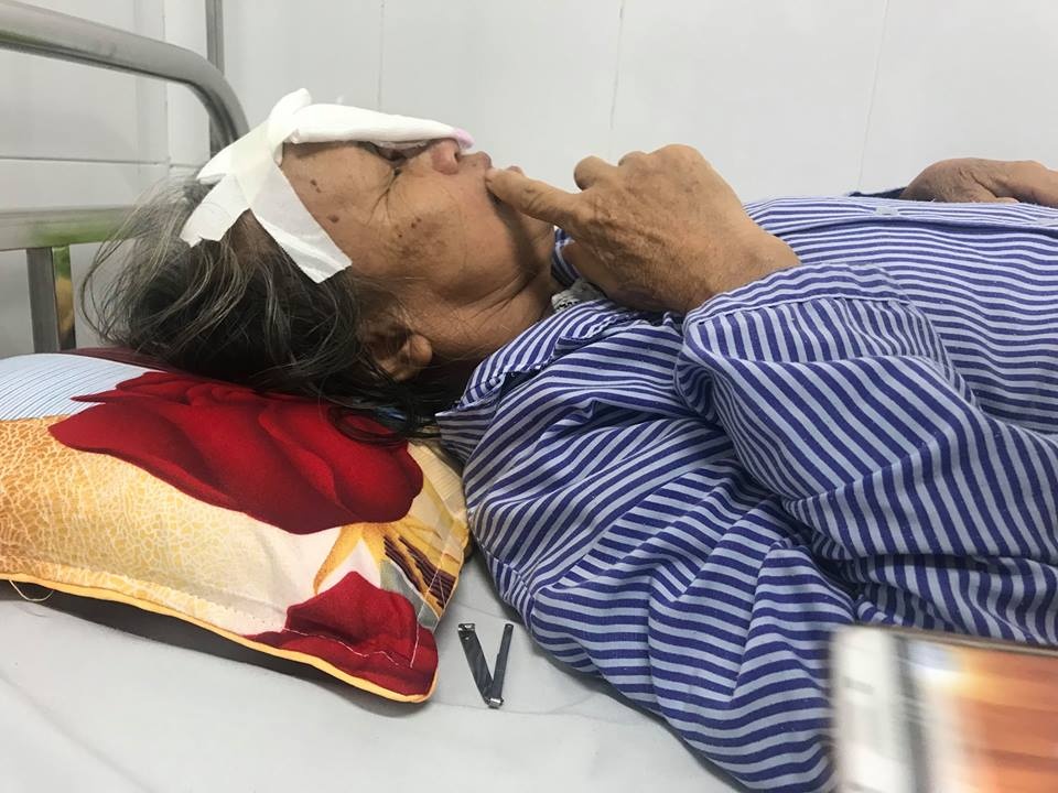 ung thư da ảnh 1 ung thu da anh 1