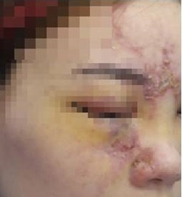 tiem filler nang mui anh 1