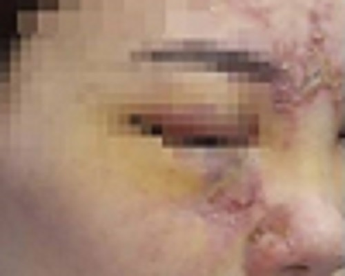 Nguy co mat mot mat sau khi tiem filler tai mot spa o Dai Loan hinh anh