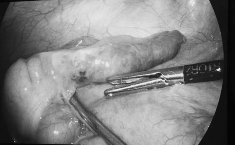 xuong ca dam thung ruot anh 1