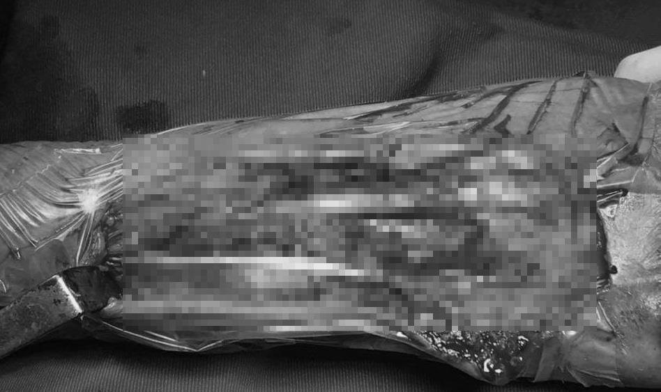 đứt gân duỗi ảnh 1 dut gan duoi anh 1