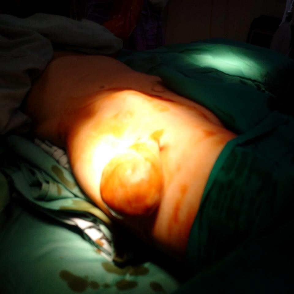 khối u mỡ thành khổng lồ ảnh 1 khoi u mo thanh khong lo anh 1