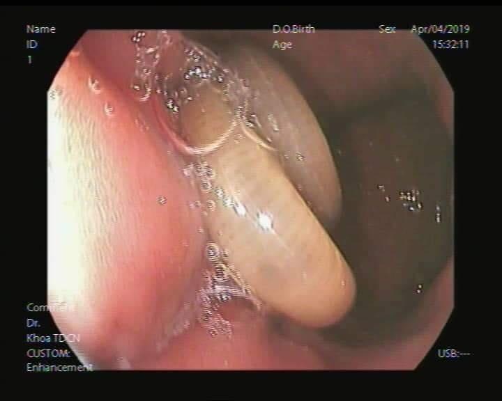 giun dua dai 15 cm trong da day anh 1