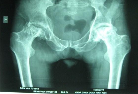 hoại tử vô khuẩn chỏm xương đùi ảnh 1 hoai tu vo khuan chom xuong dui anh 1