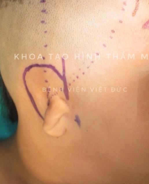 khung sụn tai nhân tạo ảnh 1 khung sun tai nhan tao anh 1