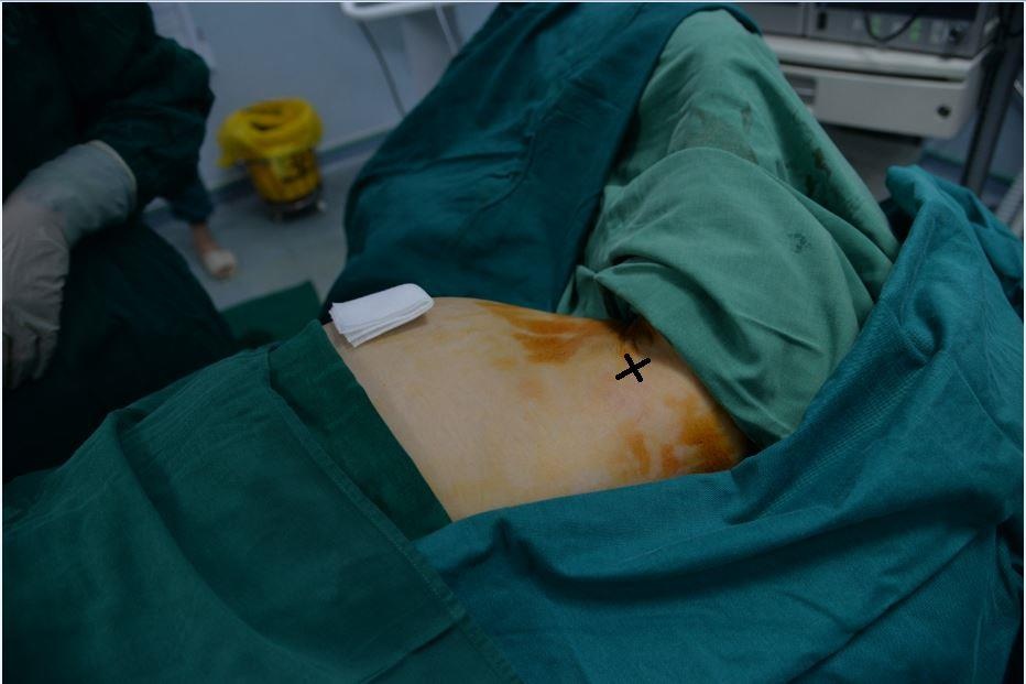 Dau tuc nguc, co gai duoc chan doan mac u xo tuyen vu hinh anh